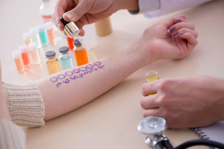 Allergy Testing
