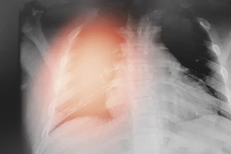 Interstitial Lung Disease (ILD) Clinic