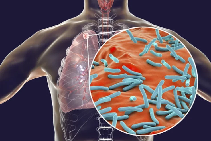 Tuberculosis (TB) Management